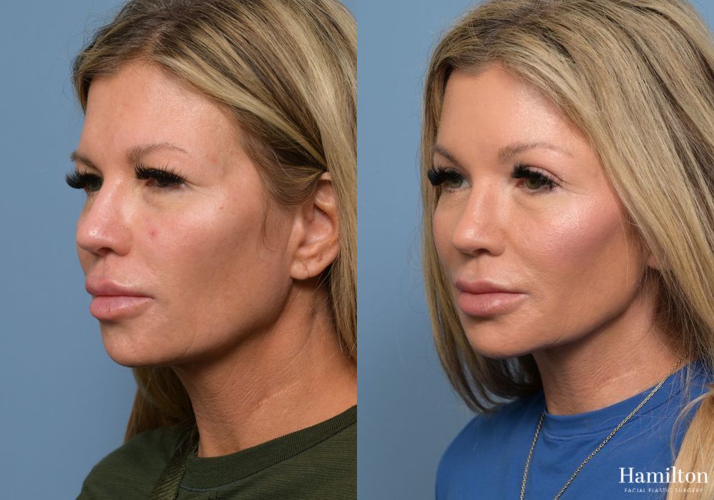 Before and after Brow Lift case 37111 - Angle 2