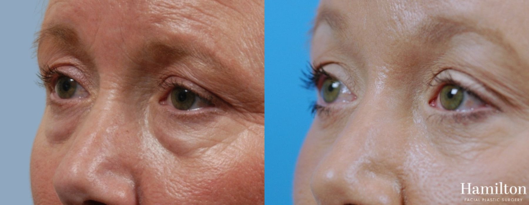 Before and after Blepharoplasty case 37284 - Angle 3