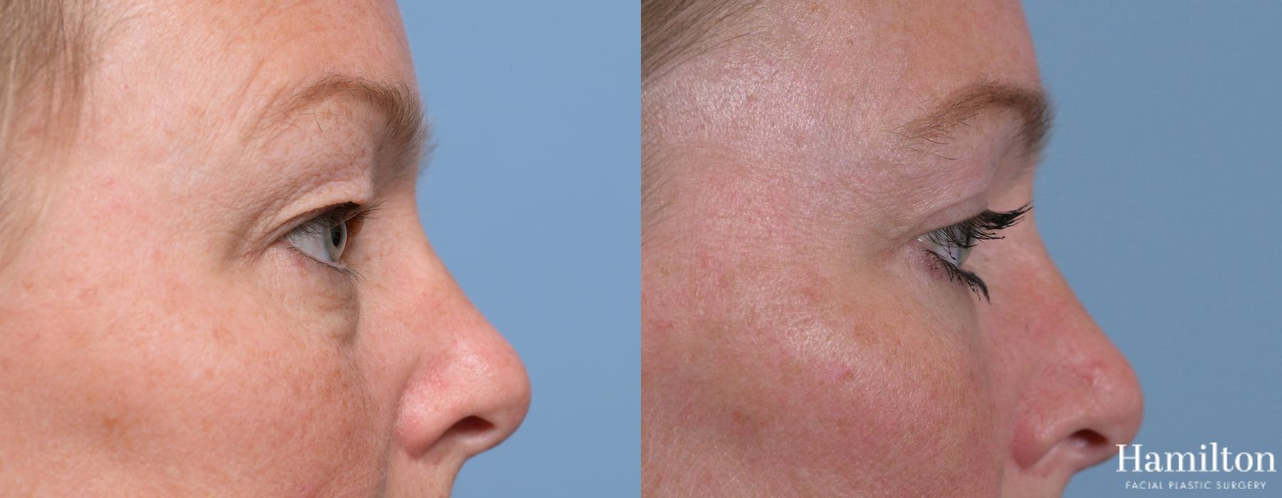 Before and after Blepharoplasty case 37119 - Angle 6