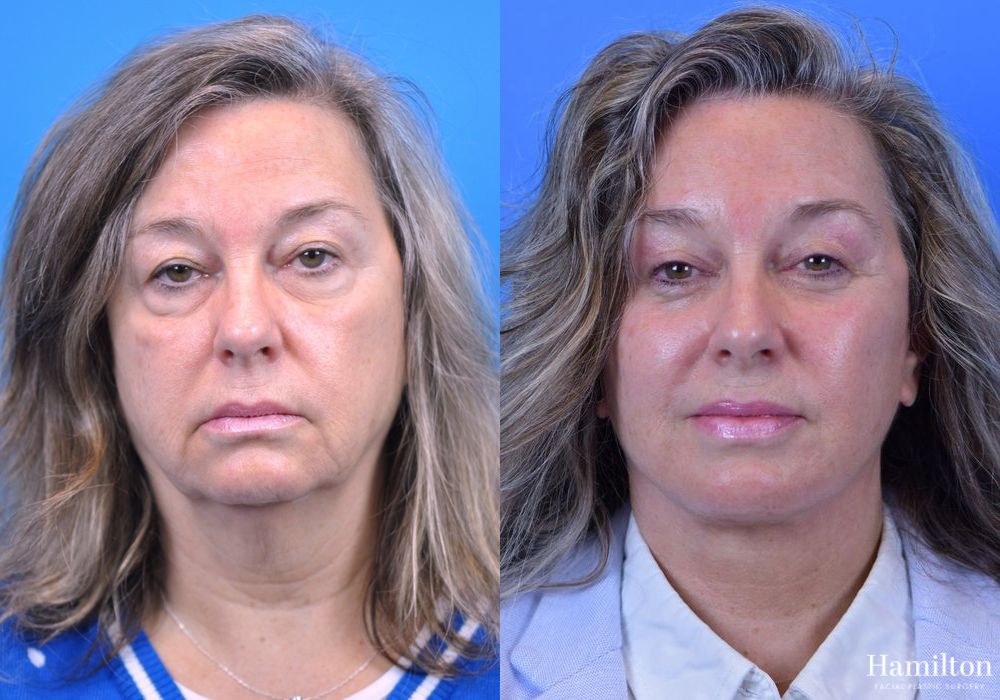 Before and after Facelift case 37294 - Angle 3