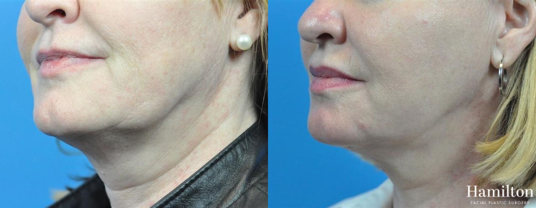 Before and after FaceTite case 37148 - Angle 4