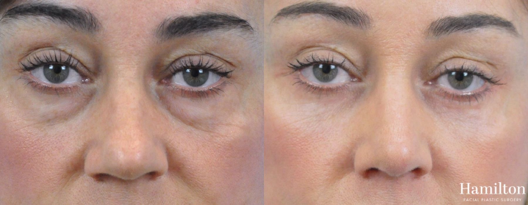 Before and after Blepharoplasty case 37285
