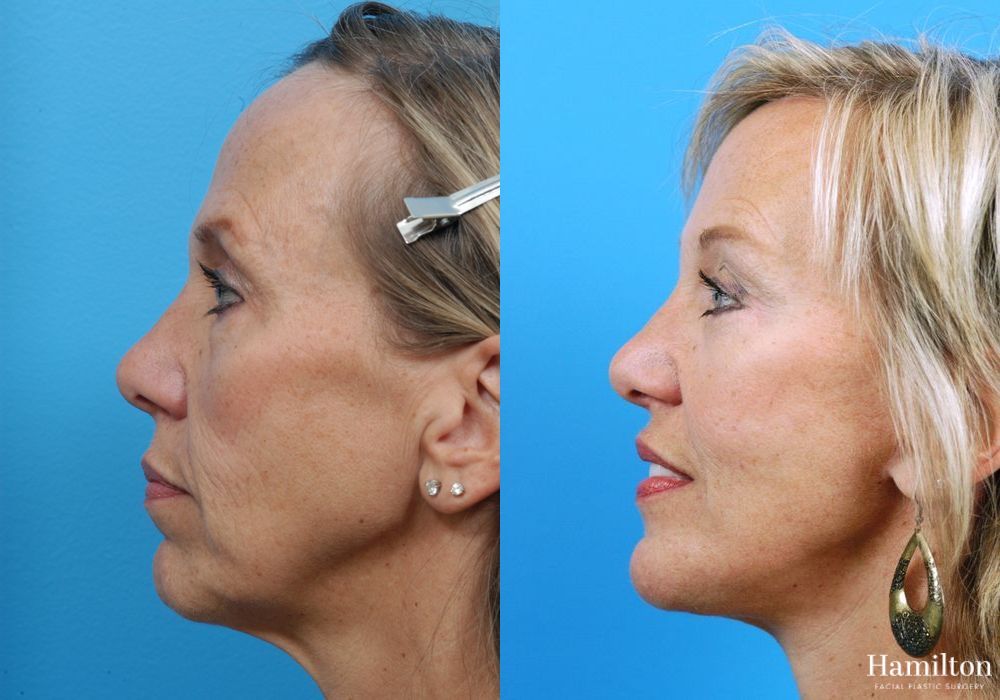 Before and after Facelift case 37286 - Angle 2