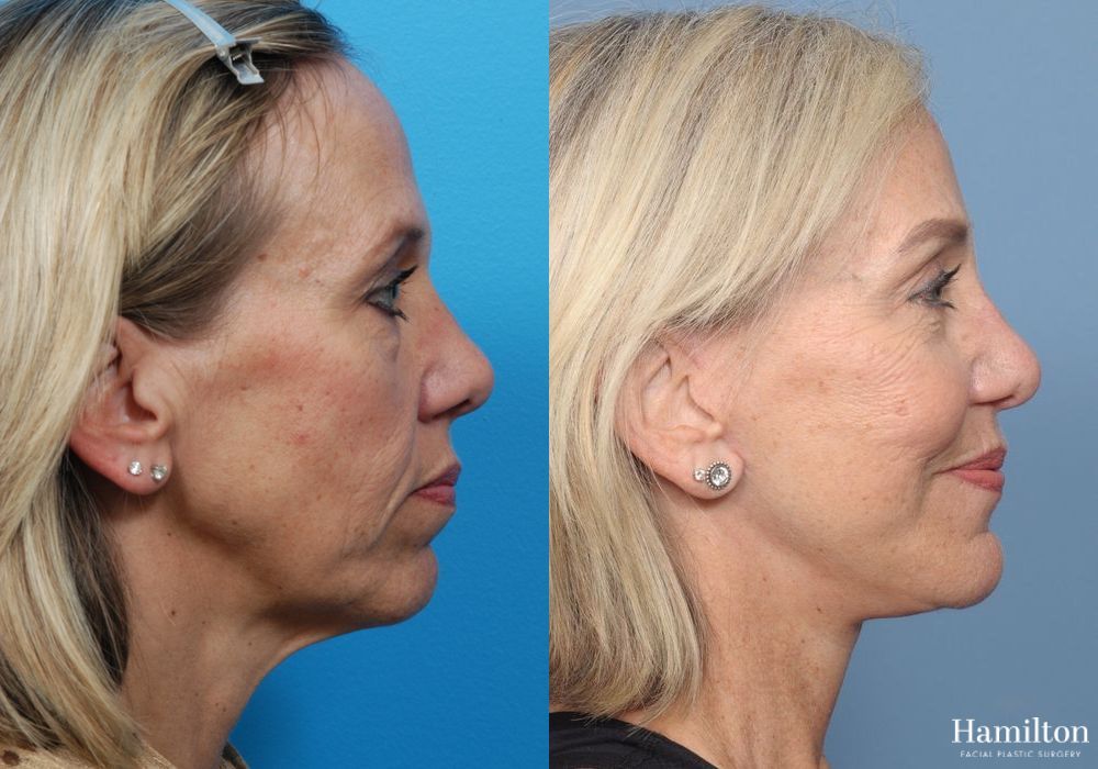 Before and after Chin Augmentation case 37147