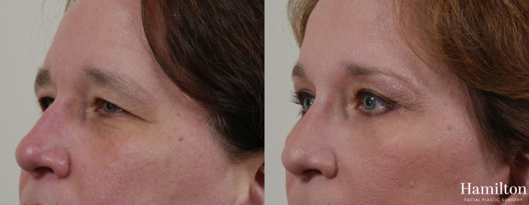 Before and after Blepharoplasty case 37270 - Angle 2