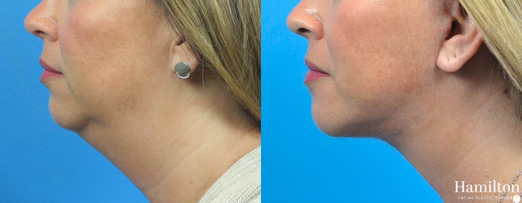Before and after Neck Rejuvenation case 37246