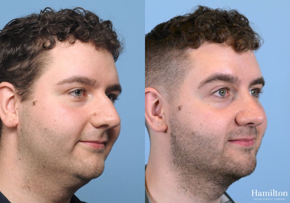 Before and after Rhinoplasty case 37236