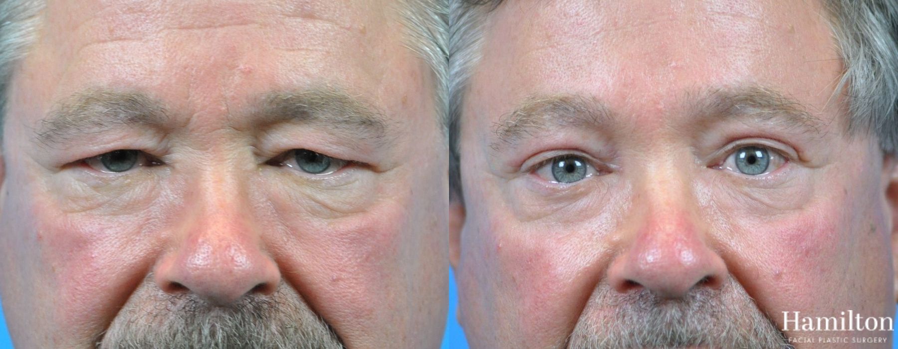 Before and after Blepharoplasty case 37319 - Angle 3