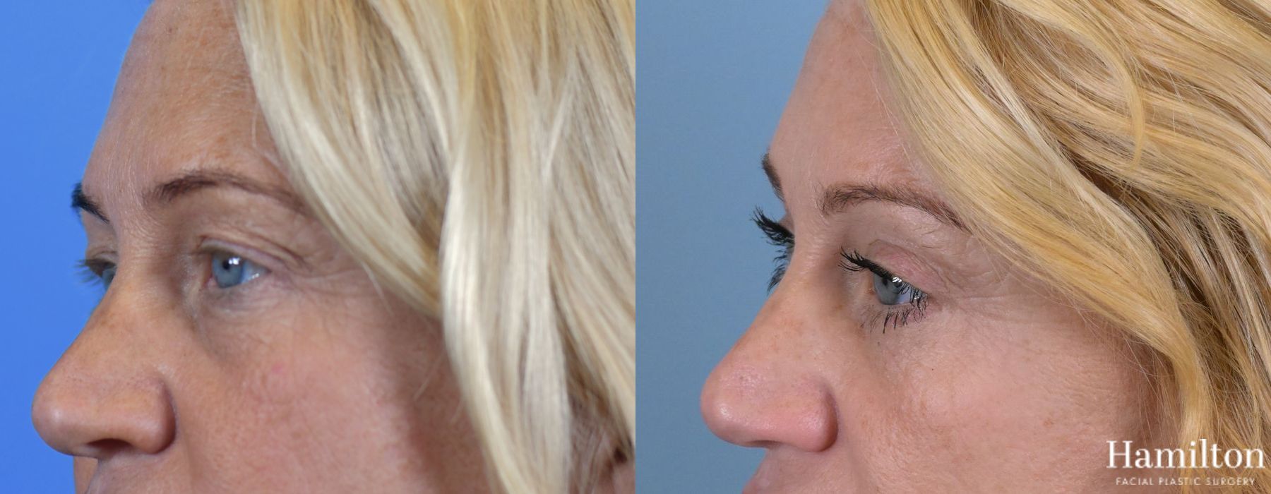 Before and after Blepharoplasty case 37289
