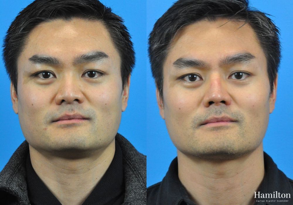 Before and after Rhinoplasty case 37288 - Angle 3