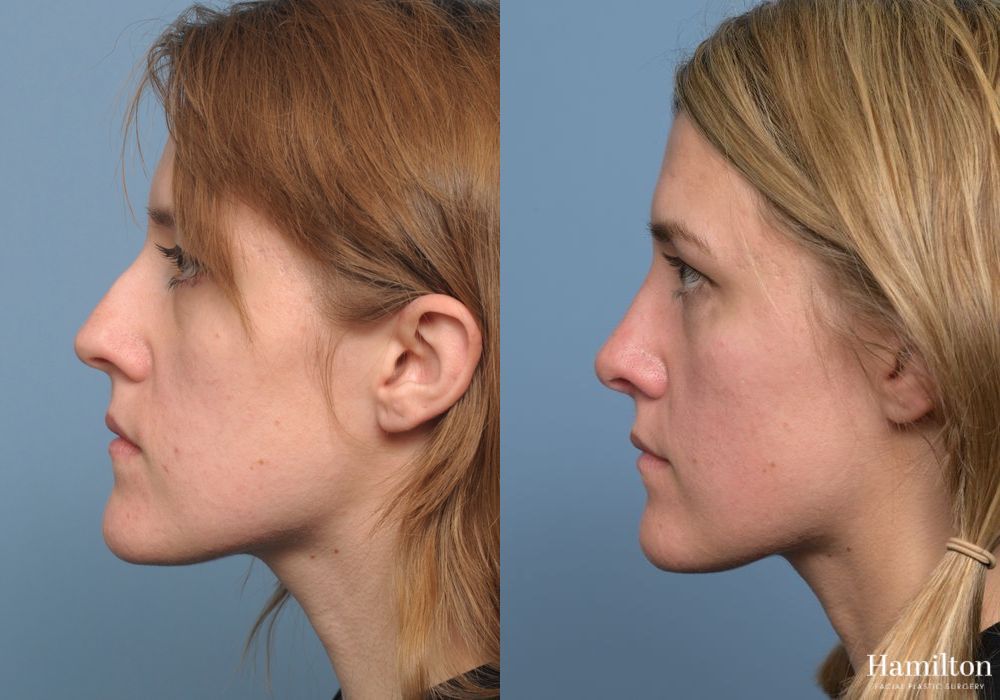 Before and after Rhinoplasty case 37136 - Angle 2
