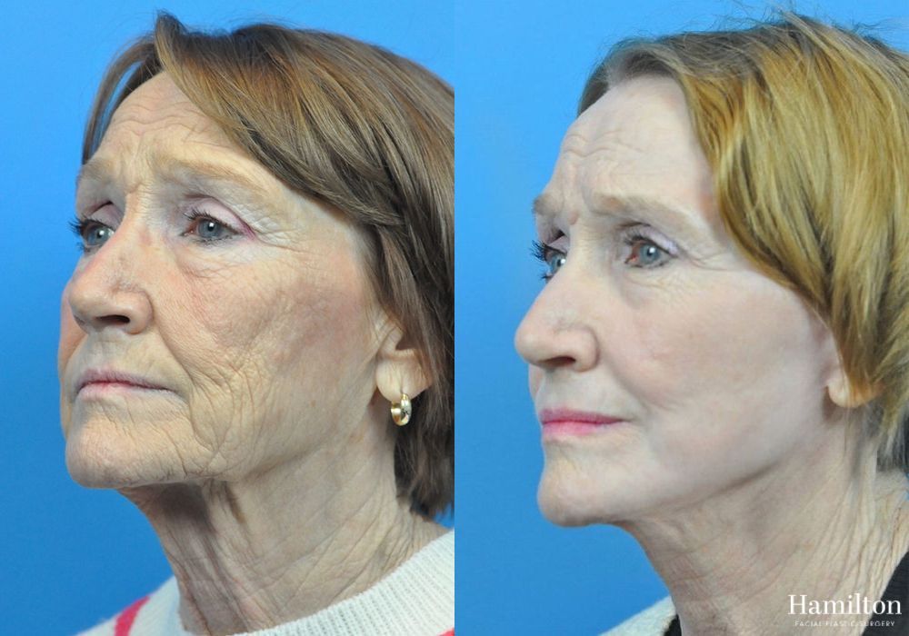 Before and after Facelift case 37320