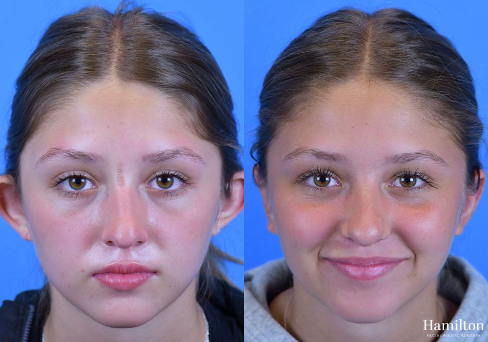 Before and after Otoplasty case 37093