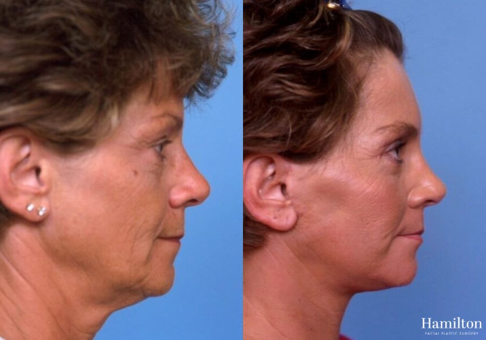 Before and after Facelift case 37324 - Angle 3