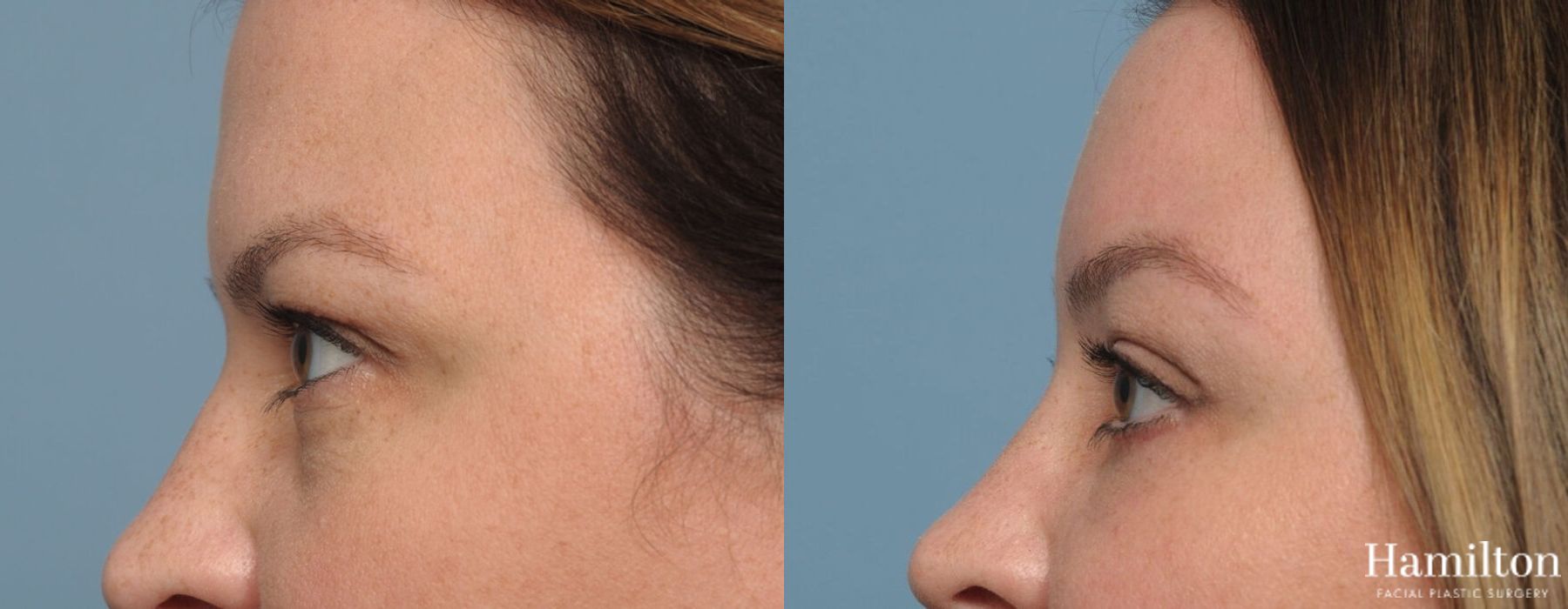 Before and after Brow Lift case 37086 - Angle 3