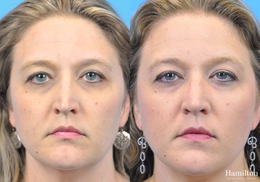 Before and after Rhinoplasty case 37330 - Angle 5