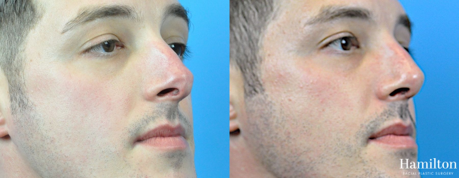 Before and after Rhinoplasty case 37333 - Angle 4