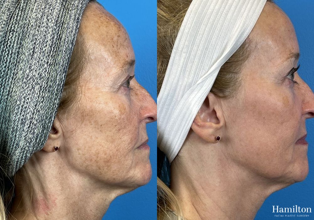 Before and after Laser - Broad Band Light (BBL) case 37099 - Angle 3