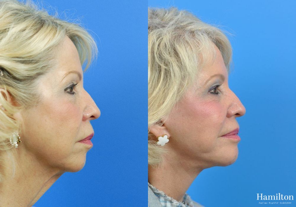 Before and after Facelift case 37314