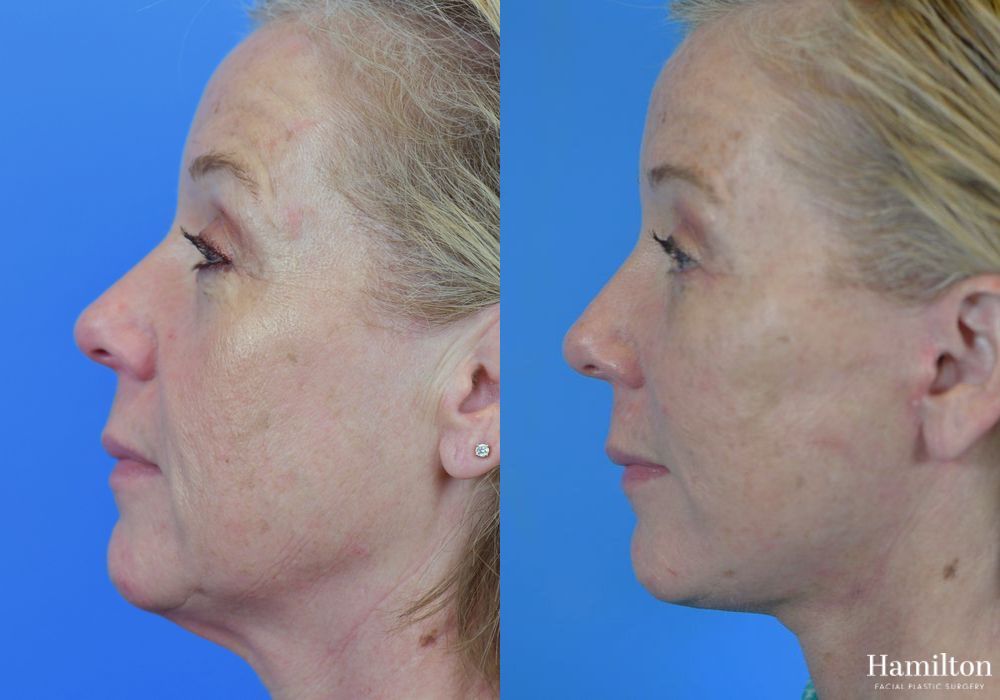 Before and after Facelift case 37316 - Angle 5