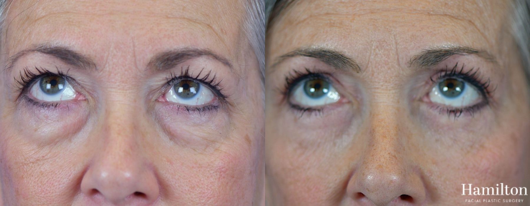 Before and after Blepharoplasty case 37267 - Angle 2