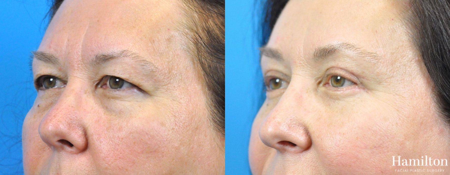 Before and after Brow Lift case 37229 - Angle 3