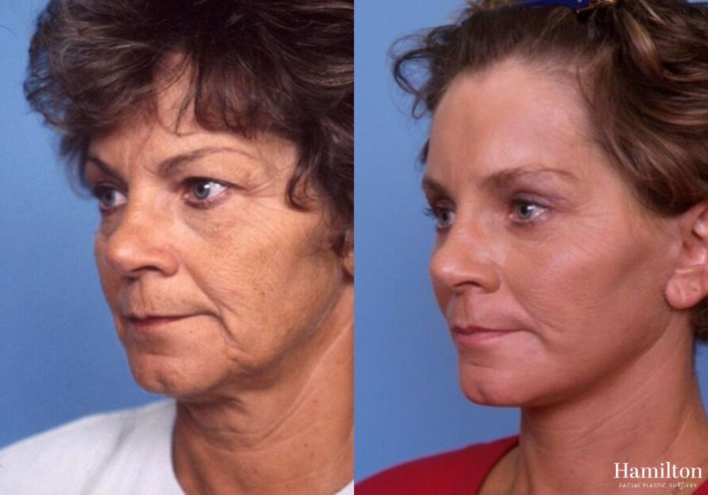 Before and after Facelift case 37324 - Angle 2