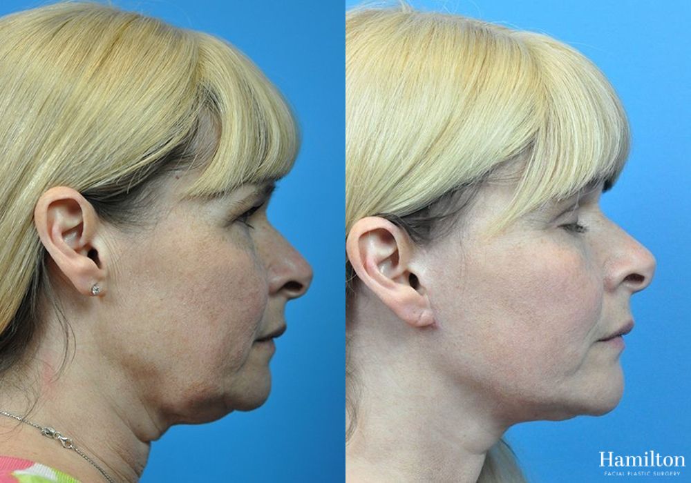 Before and after Facelift case 37261 - Angle 3