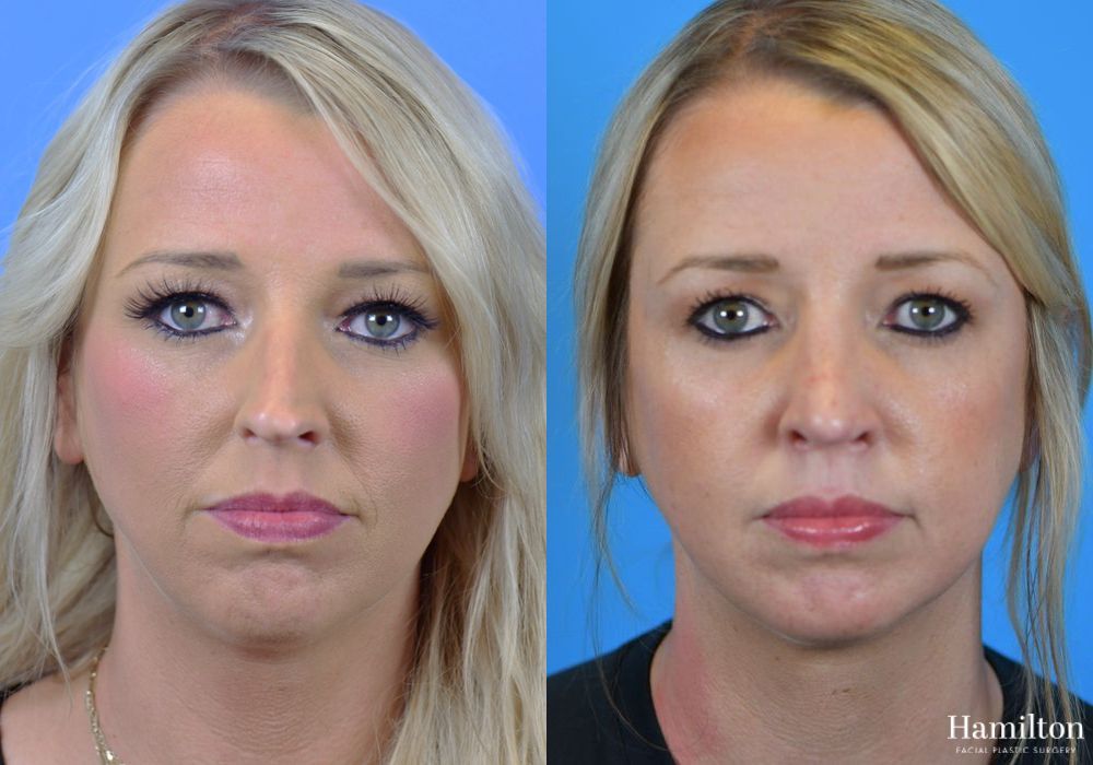 Before and after Rhinoplasty case 37259 - Angle 2