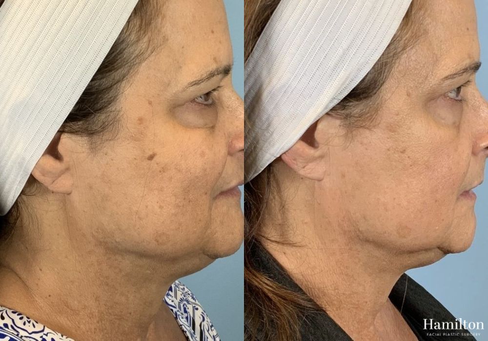 Before and after Laser - Broad Band Light (BBL) case 37228