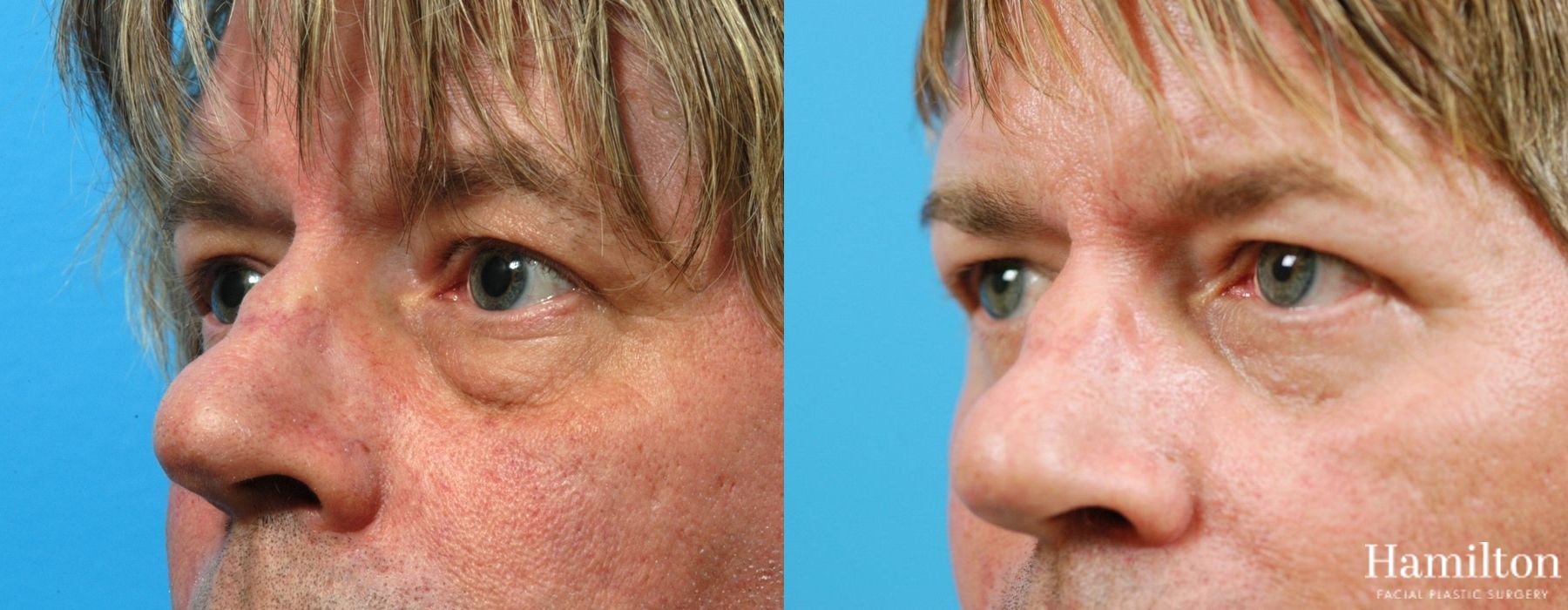 Before and after Blepharoplasty case 37309 - Angle 3