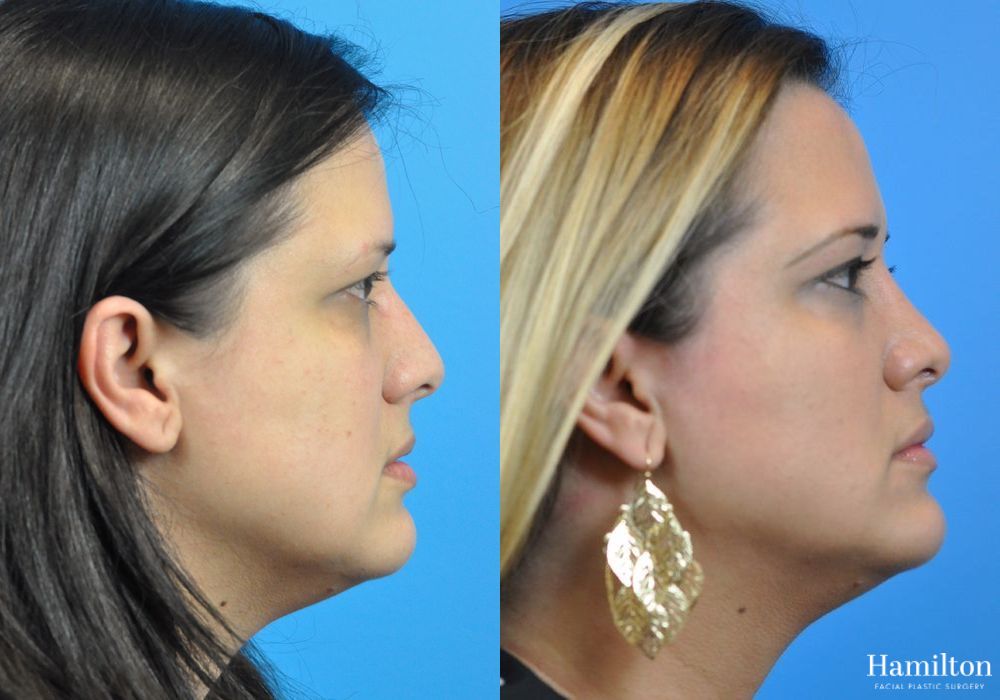 Before and after Rhinoplasty case 37327 - Angle 2