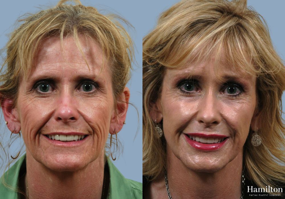 Before and after Laser - CO2 case 37154