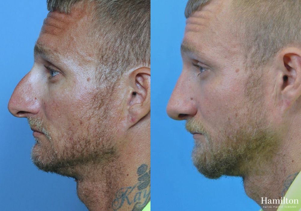 Before and after Rhinoplasty case 37303