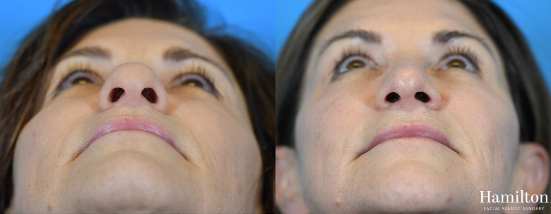 Before and after Rhinoplasty case 37299 - Angle 6