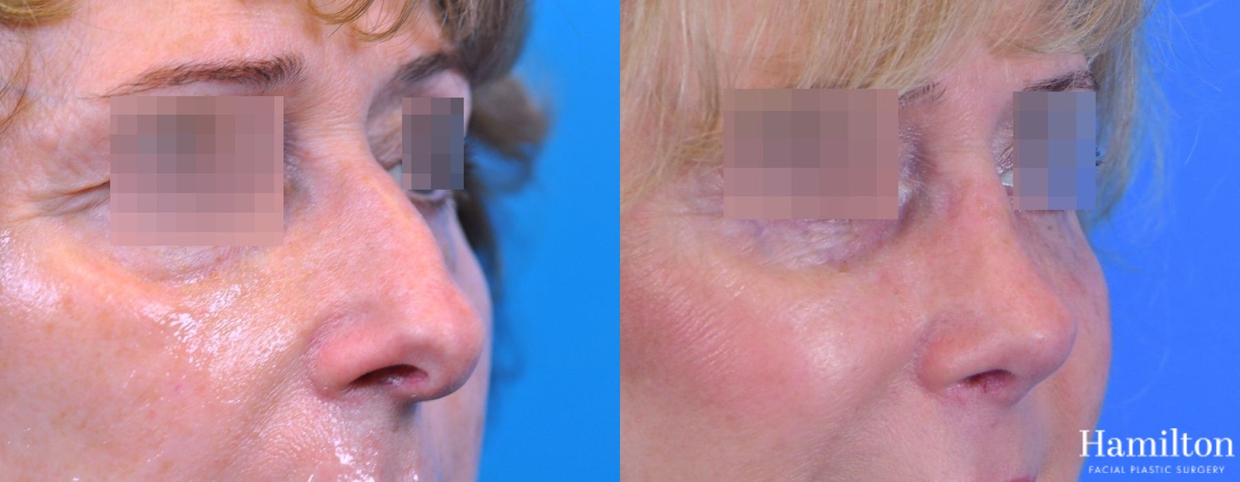 Before and after Rhinoplasty case 37352 - Angle 2