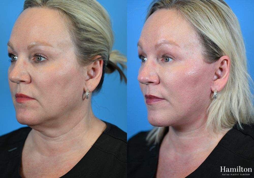 Before and after Facelift case 37317 - Angle 3