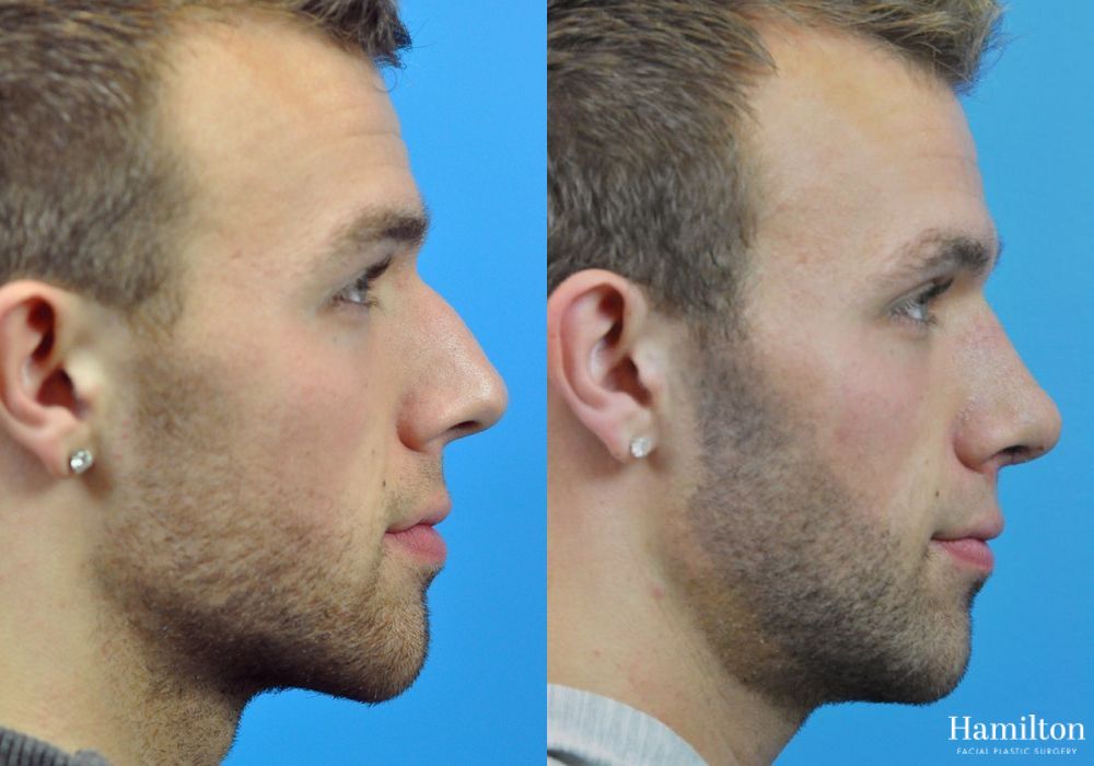 Before and after Rhinoplasty case 37250 - Angle 2