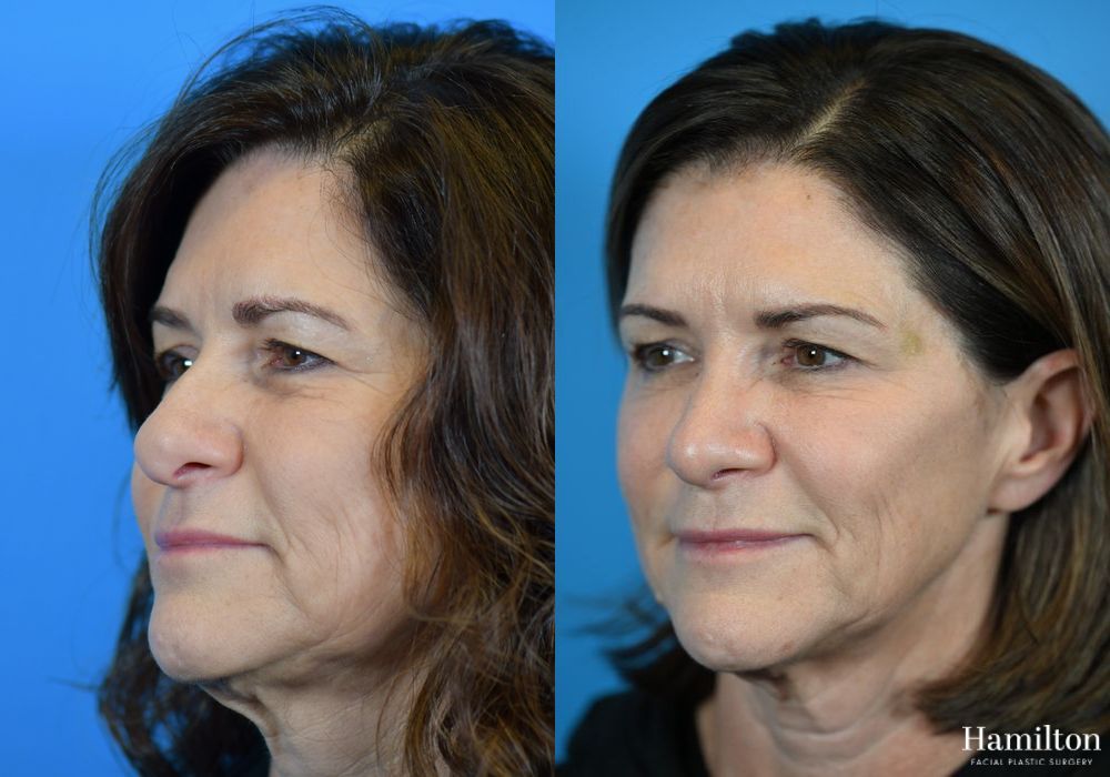 Before and after Rhinoplasty case 37299 - Angle 3