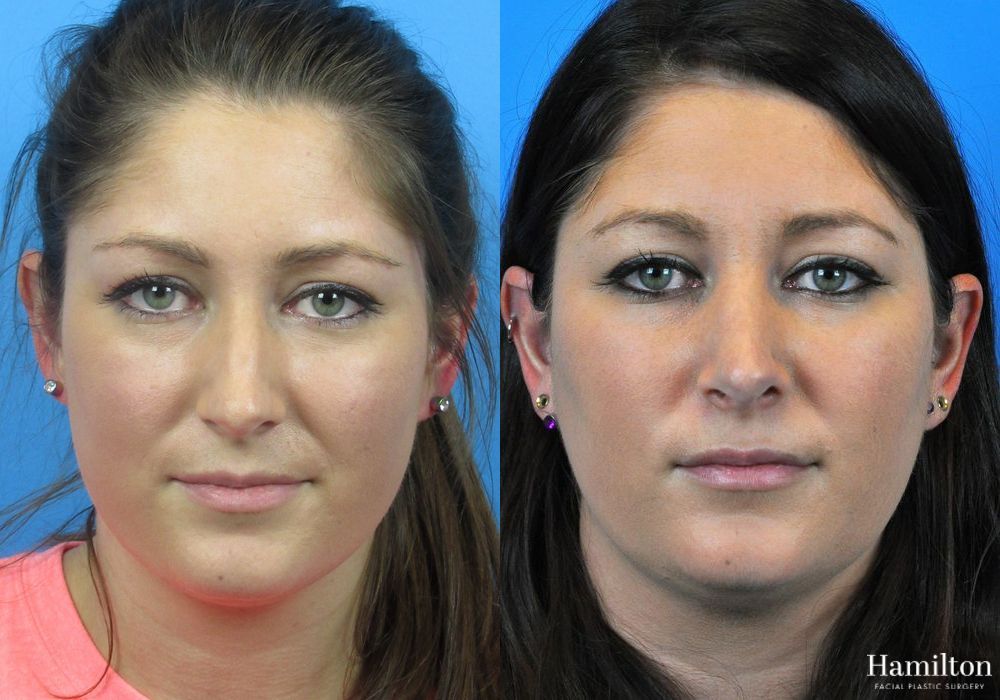 Before and after Rhinoplasty case 37356 - Angle 5