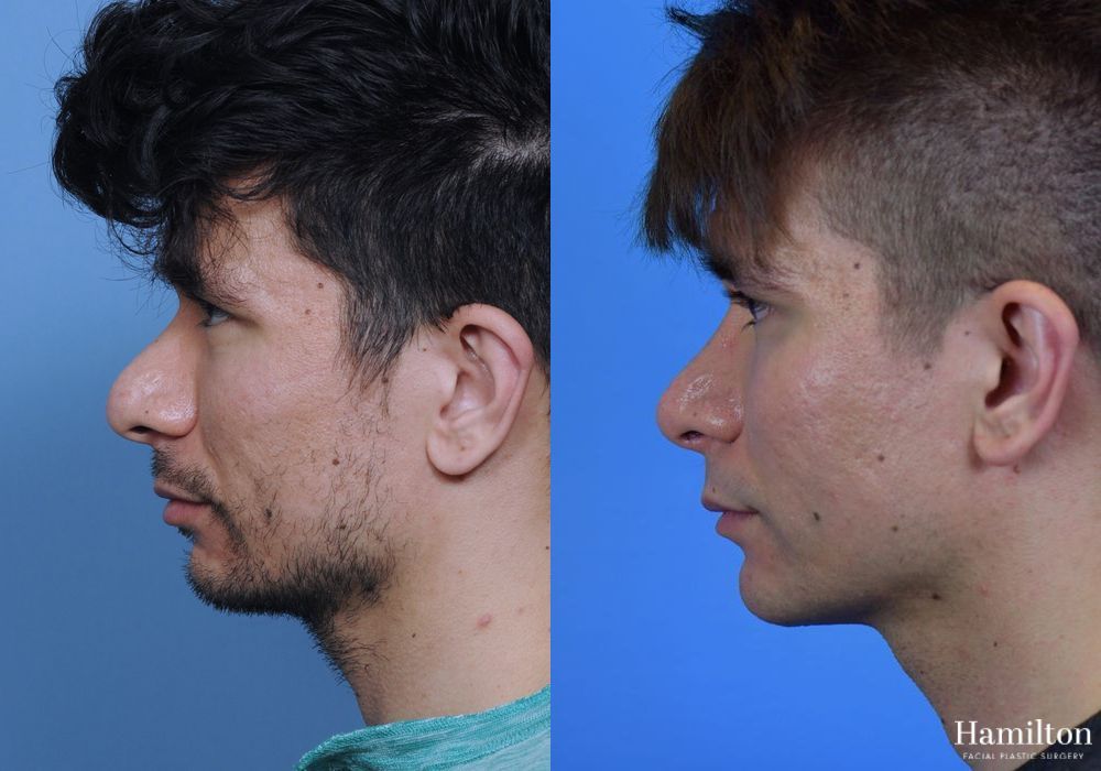 Before and after Rhinoplasty case 37271 - Angle 2