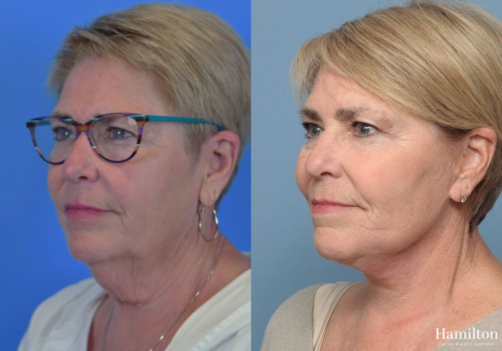 Before and after Facelift case 37290 - Angle 3