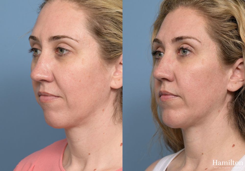 Before and after Chin Augmentation case 37179 - Angle 3