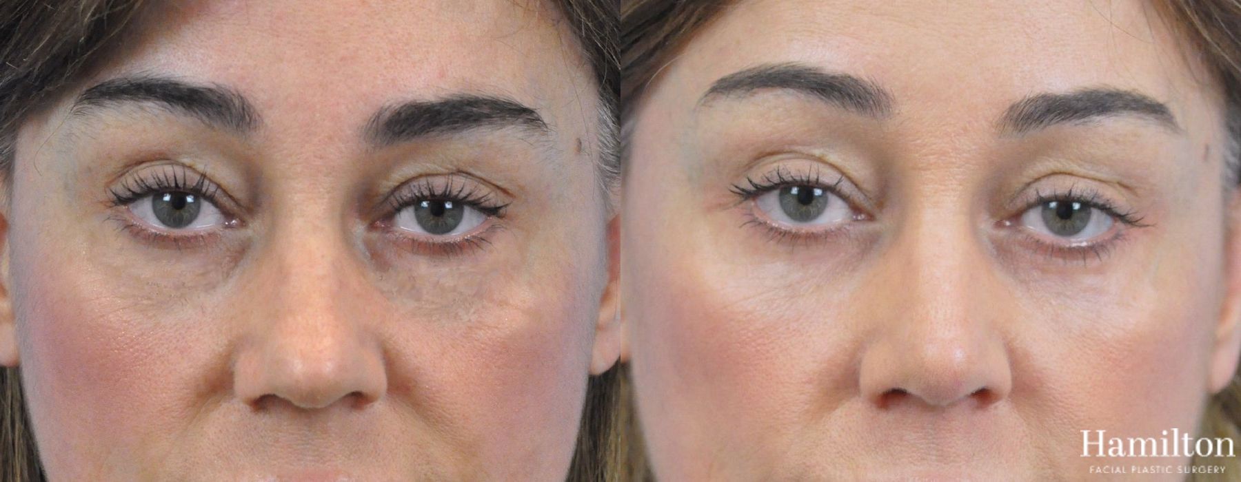 Before and after Rhinoplasty case 37329 - Angle 5