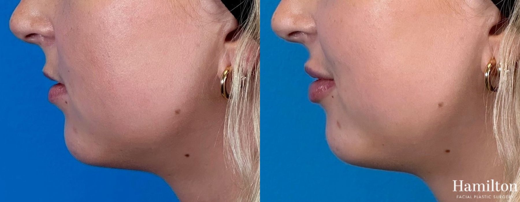 Before and after Lip Enhancement case 37106 - Angle 3