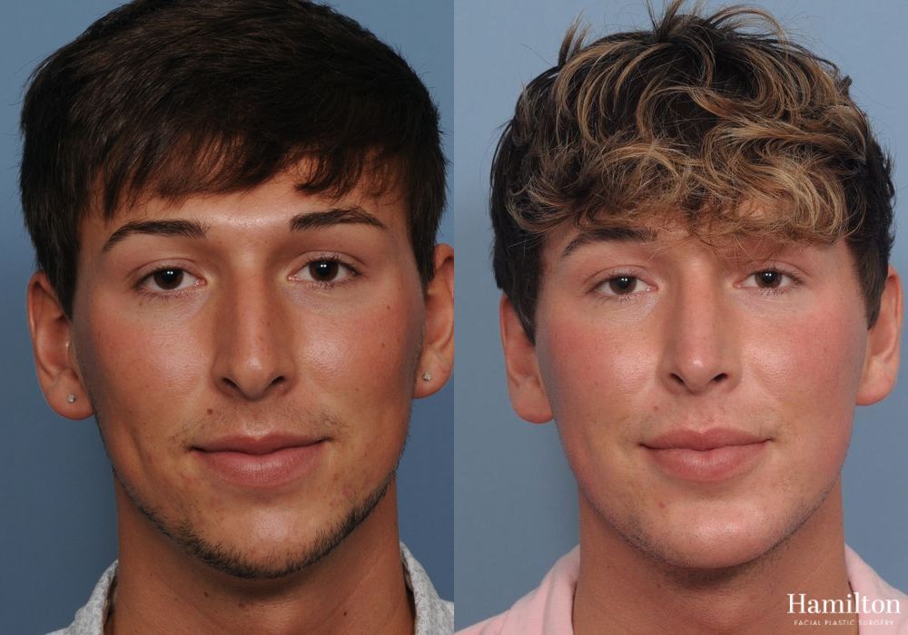 Before and after Chin Augmentation case 37085 - Angle 4