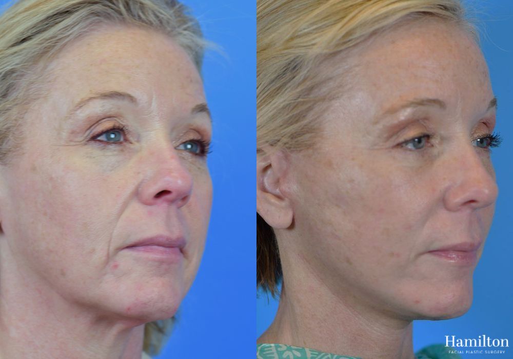 Before and after Facelift case 37316 - Angle 4