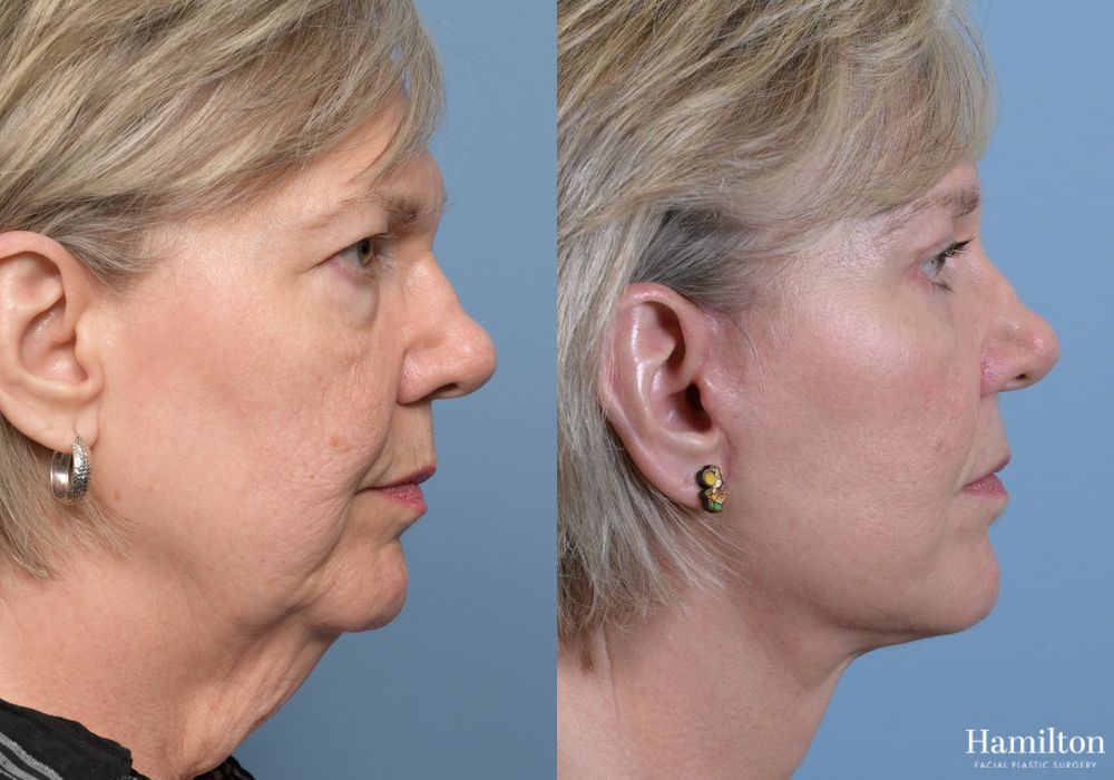 Before and after Neck Rejuvenation case 37113 - Angle 2