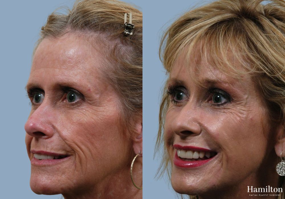 Before and after Laser - CO2 case 37154 - Angle 2