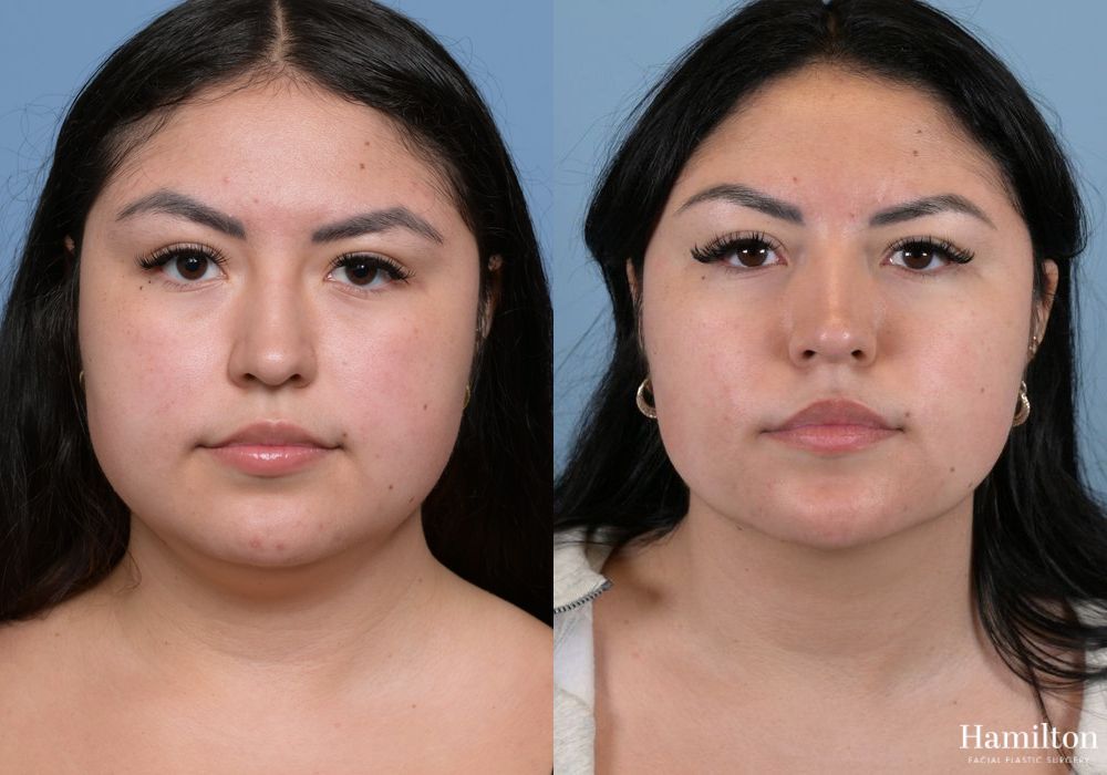 Before and after Submentoplasty/Deep Neck Lift case 37132 - Angle 4